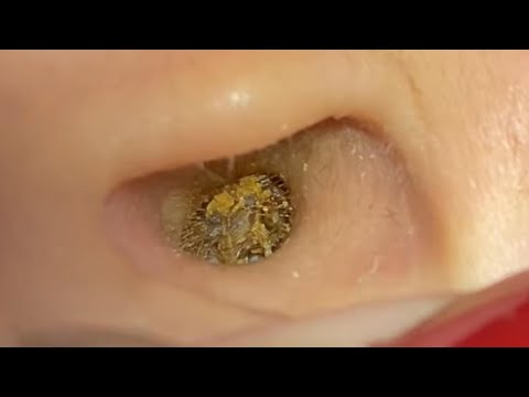 ASMR Ear Cleaning – We’ve NEVER Seen a Case This Severe