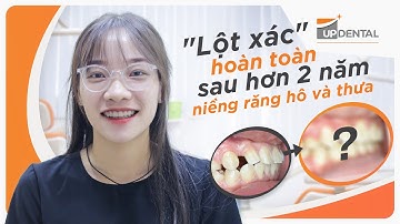 "Lột xác" hoàn toàn sau hơn 2 năm niềng răng hô và thưa