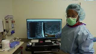 Full-endoscopic Spine Surgery performed by Dr. Nwosu / Neospine Seattle WA