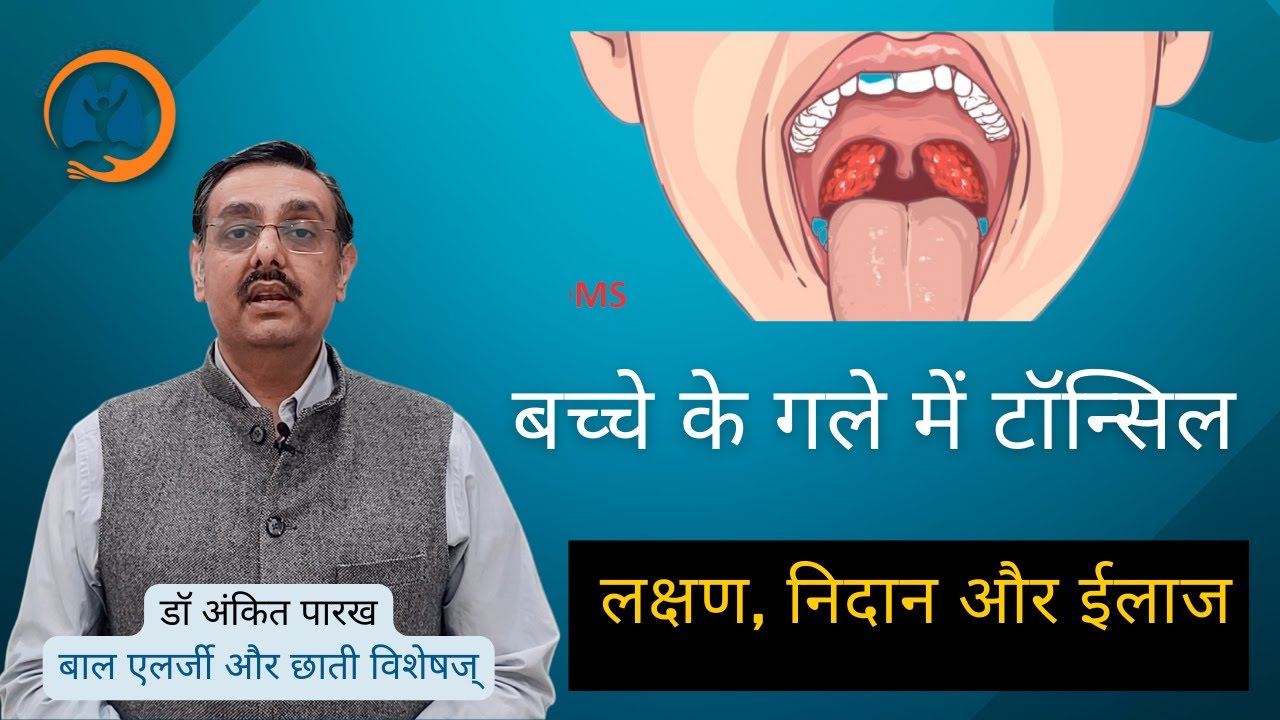 बच्चे के गले में टॉन्सिल (Tonsillitis in children):