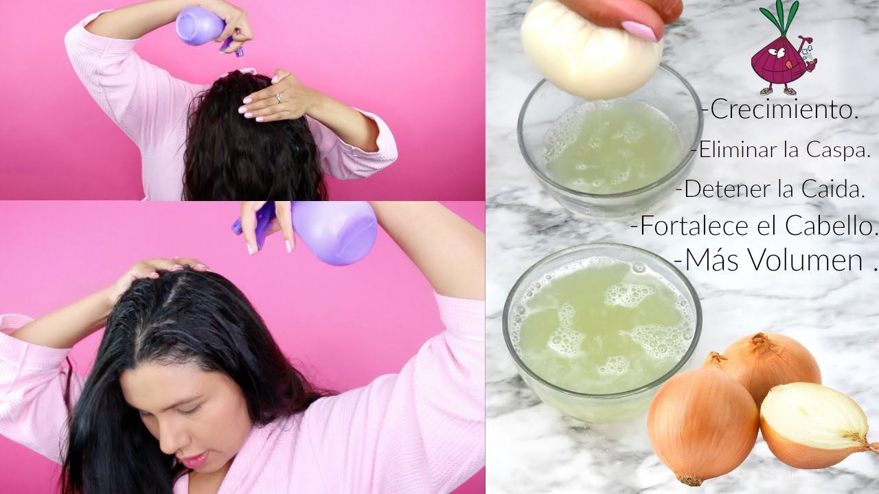 gancho Fraternidad Prisión Jugo de Cebolla Para Eliminar la Caspa, Hacer crecer el cabello y Detener la  Caida -fashionbycarol - YouTube