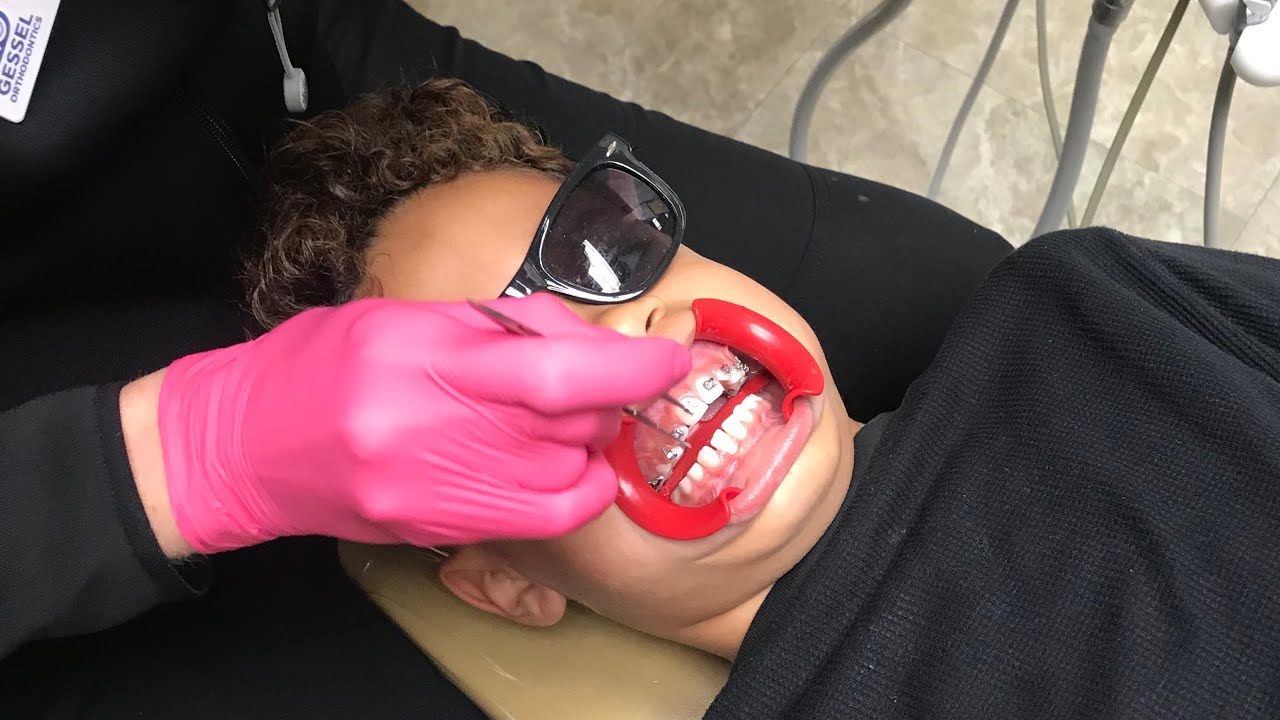 LISTON FINALLY GETS HIS BRACES!!!! | TEAM BROS