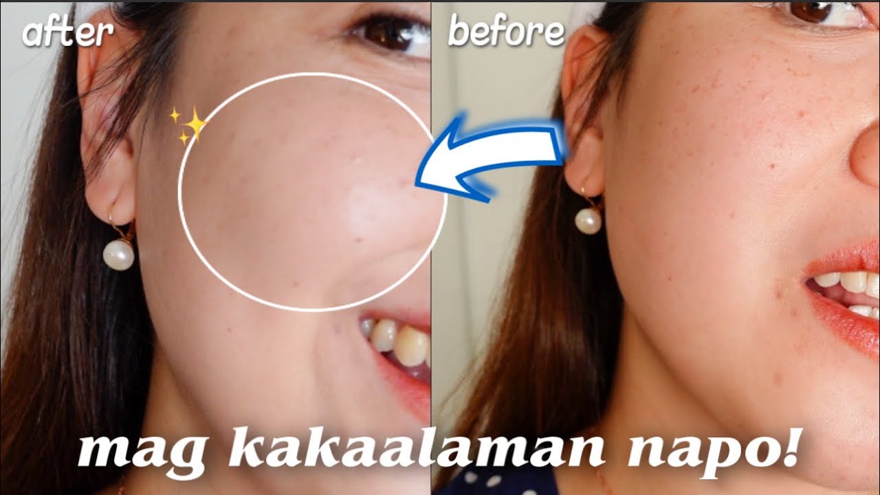MY NO1. MELASMA SUNSCREEN VS BELO SUN EXPERT TINTED SUNSCREEN 2023