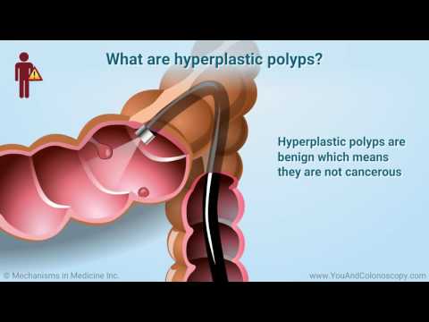 Video: Kas yra fibrozinė kolonopatija?