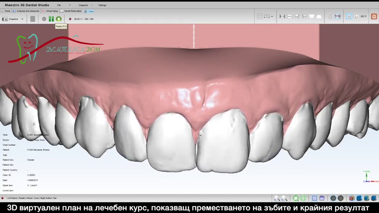 ПРАВИ ЗЪБИ с невидими шини-Алайнери