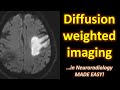 Diffusion weighted imaging dwi in neuroradiology made easy