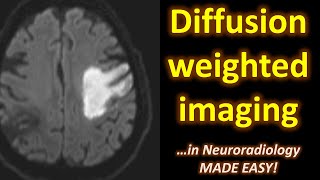 Diffusion Weighted Imaging (DWI) in Neuroradiology... made easy!