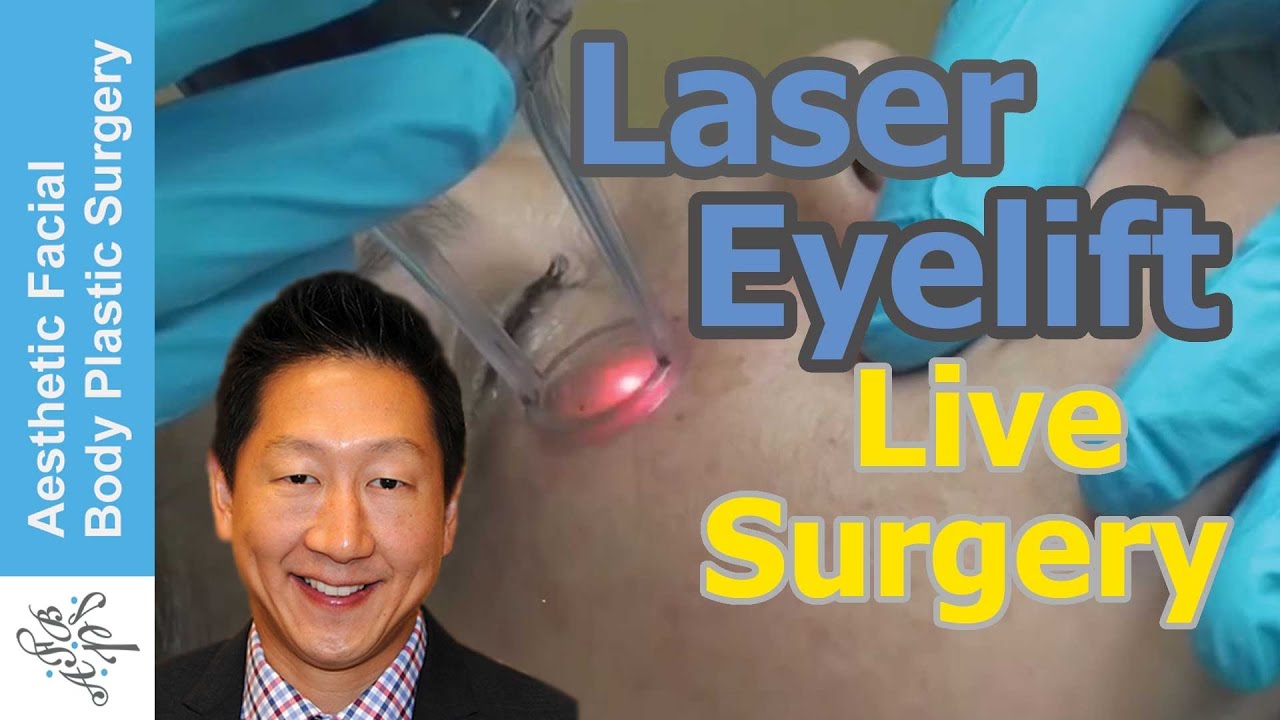 Fractional Laser Eyelid Lift Blepharoplasty by Dr. Philip Young