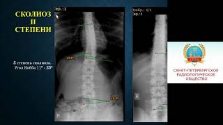 Рыбка Д.О. «Лучевая диагностика сколиоза»