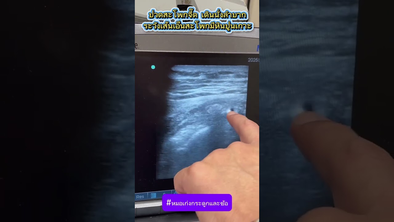 ปวดสะโพกจี๊ด เดินนั่งลำบาก ระวังเส้นเอ็นสะโพกมีหินปูนเกาะ