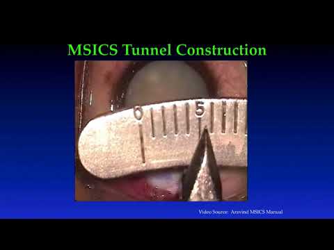 Tunnel Construction and Nucleus Prolapse - Steve Anderson MD