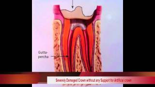 Illustrative Explanation of Post & Core in Dentistry