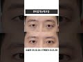 비절개눈매교정으로 짝눈교정하기 #남자눈성형 #쌍수기록 #비절개눈매교정