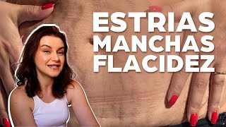 Como cuidar de Estrias, Flacidez e Manchas | Especial dia das Mães