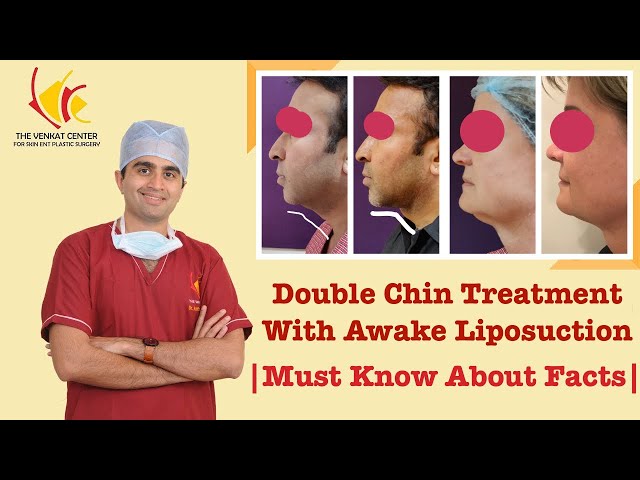 Double chin treatment with awake liposuction | Must Know about Facts| Before & After Images Included