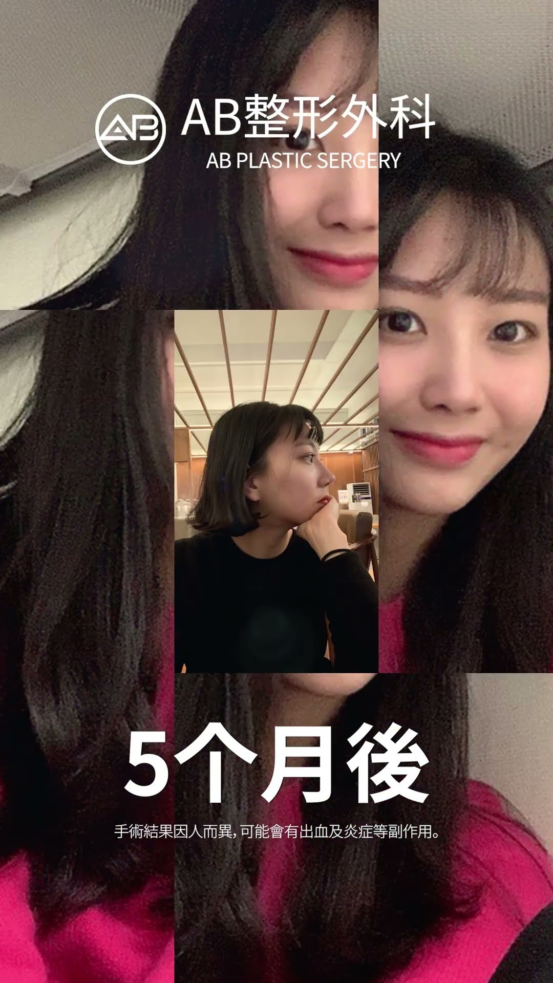 「隆鼻手术惊艳变身！😍✨ 看她的华丽蜕变！」#热门 #推荐