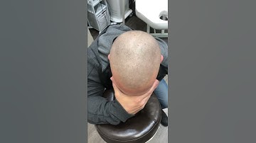 Scalp Micropigmentation Healed results after first session