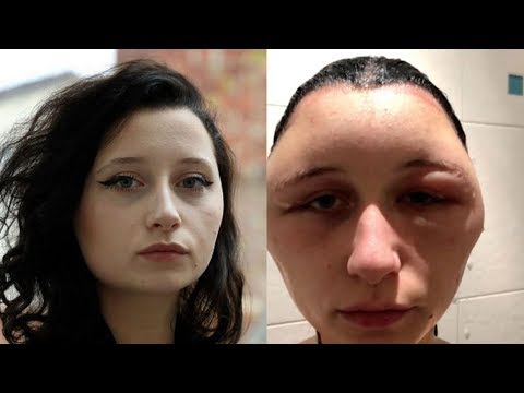 Video: Kepala Seorang Wanita Yang Bengkak Menjadi Tiga Kali Lipat Setelah Mewarnai Rambutnya
