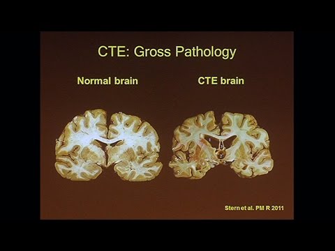 Video: Kliniske Undertyper Af Kronisk Traumatisk Encephalopati: Litteraturgennemgang Og Foreslåede Diagnostiske Kriterier For Traumatisk Encephalopati Syndrom