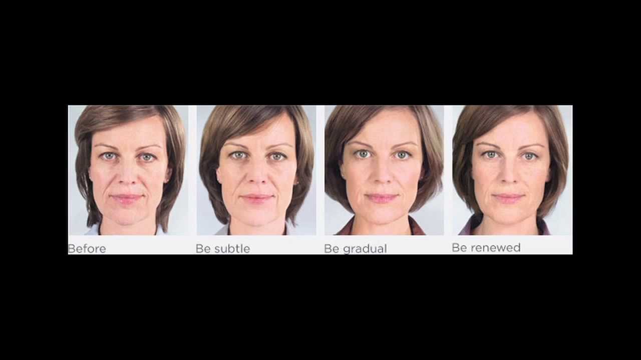 Sculptra at the Laronn Clinique