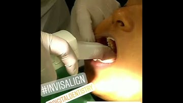 Digital Dental Scanning by iTero scanner for Invisalign clear aligner