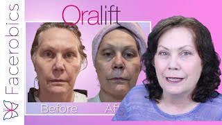 ORALIFT & Facerobics Trial Results | See My RESULTS | I Am Thrilled!