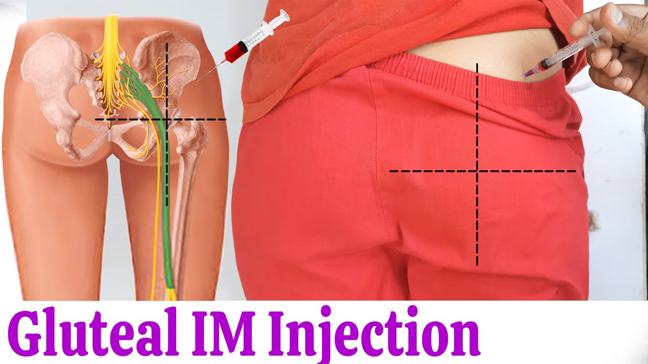 Download How to give  IM (Intramuscular) injection in buttock or hip easily at home | Dorsogluteal Injection