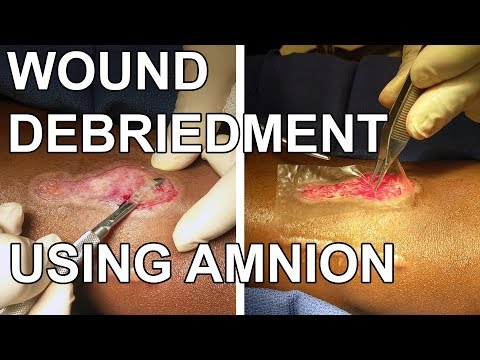 Video: Debridement: Types, Recovery, Complications & More