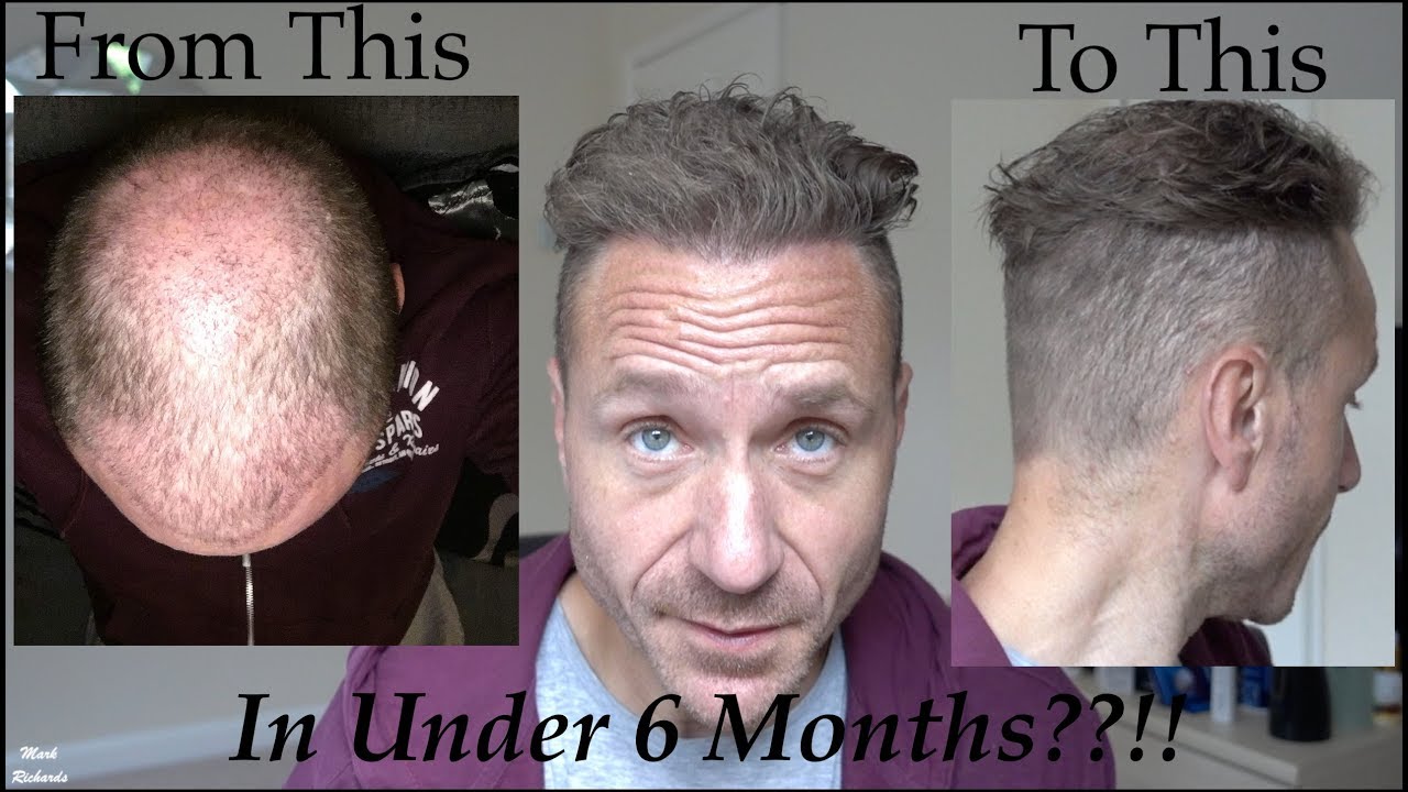 Hair Transplant in Turkey Cost Calculator - Check Exact Cost