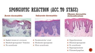 4- Spongiotic Dermatitis