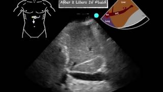 POCUS Cardiac IVC Change with fluids