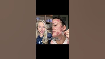 Dermatologist Reacts to Hydrocolloid Pimple Patch Removal #shorts