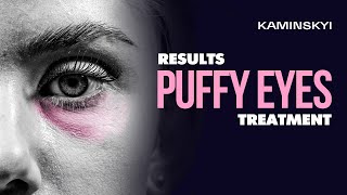 Puffy eyes. Analysis, result, recovery and rehabilitation / KAMINSKYI