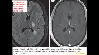 39. Multiple Sclerosis Periventricularjuxtacorticalcallosal, Demyelination, Blood Brain Barrier