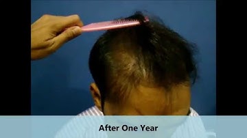 Follicular Unit Transplantation (FUT) Surgery - 3 | Hair Transplant Surgery| Dr. Anand Joshi