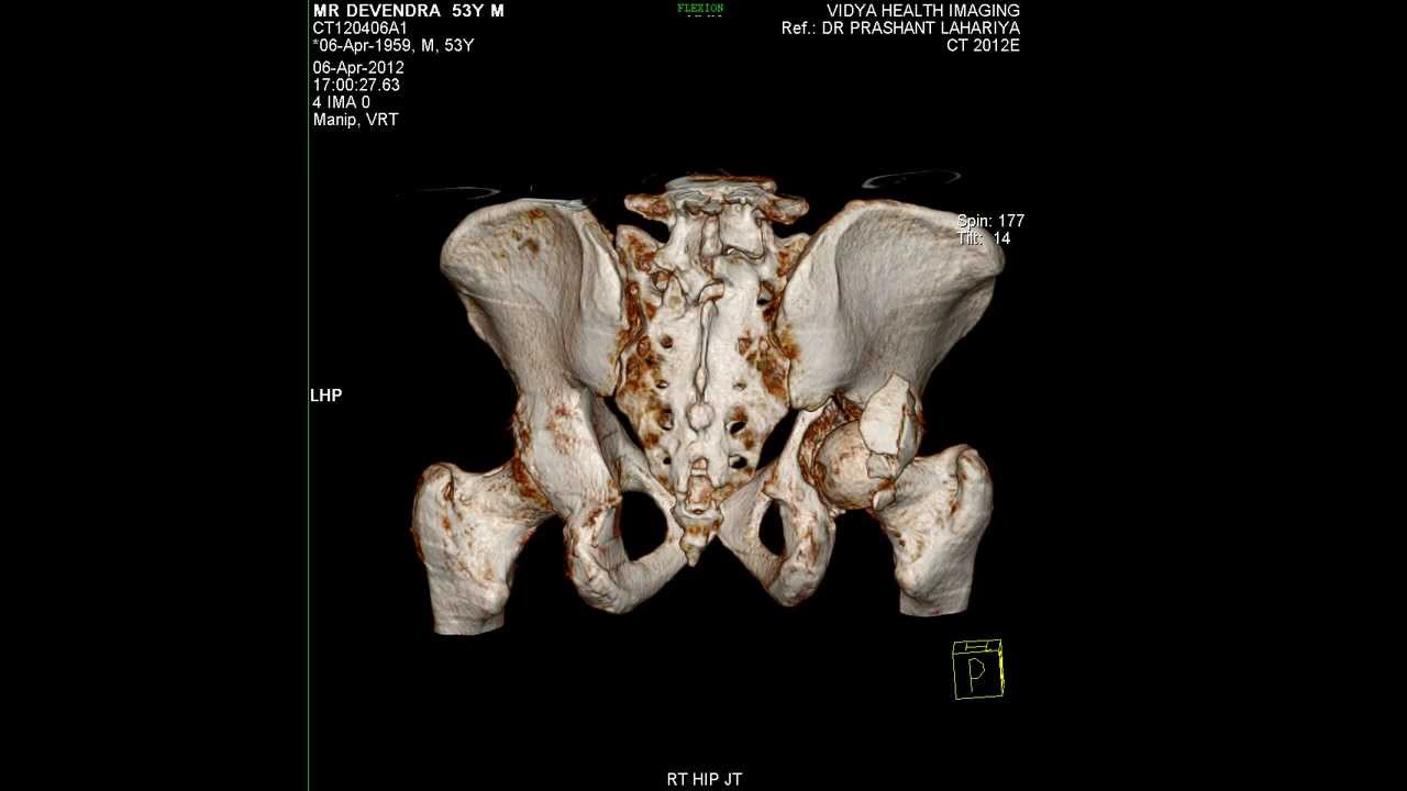 3 D CT SCAN OF FRACTURED RT HIP JOINT - YouTube