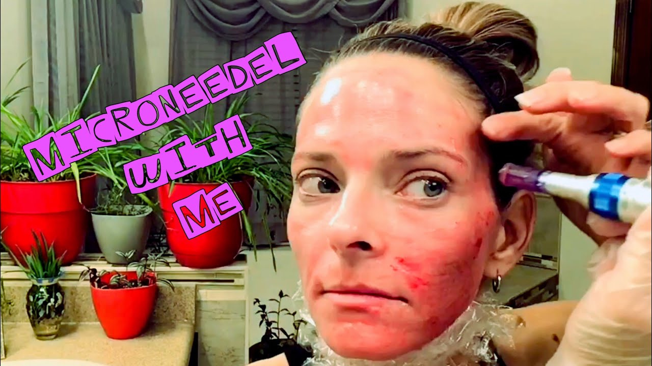 MICRONEEDELING AT HOME DR PEN BEFORE AND AFTER (month 1) YouTube