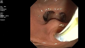 ERCP ; CBD stone suppurative cholangitis.