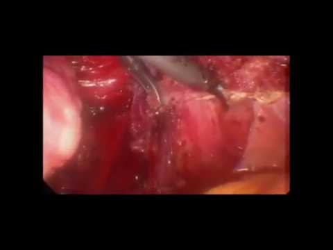 Vídeo: O Perfil Metabolômico Do Endométrio Revela Potenciais Biomarcadores Para O Diagnóstico De Endometriose Em Estágios Mínimo-leve