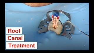 Root Canal Treatment