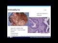 Tumores de ovario grupo 2