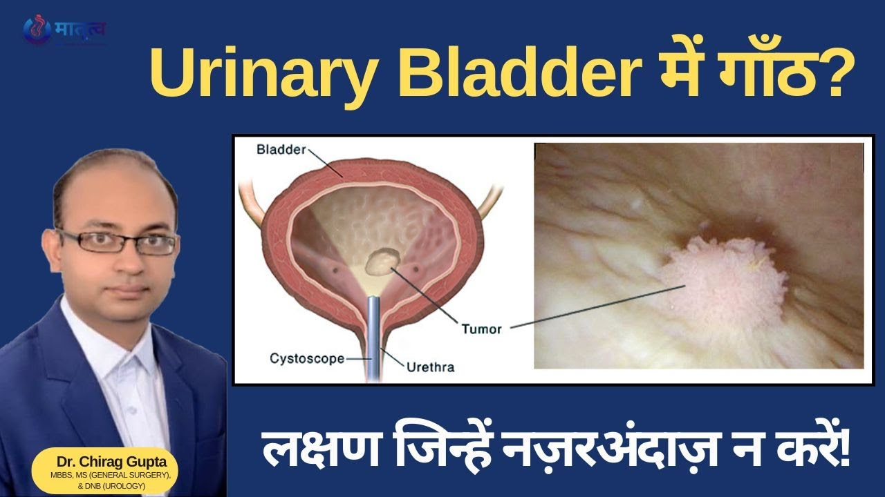 Urinary Bladder की गाँठ खतरनाक है या नहीं? | मूत्राशय की गाँठ:  किन लोगों को है  खतरा | पूरी जानकारी