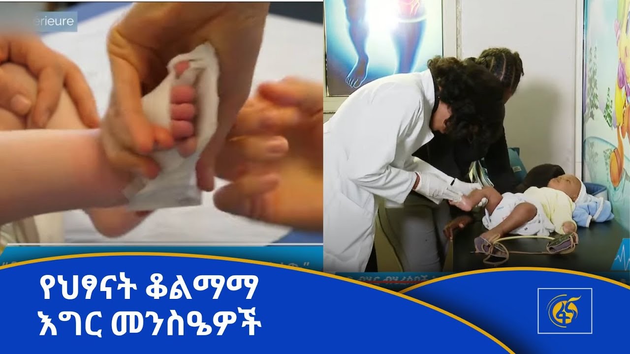 የህፃናት ቆልማማ እግር መንስዔዎች