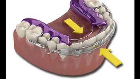 What is an Inman Aligner?