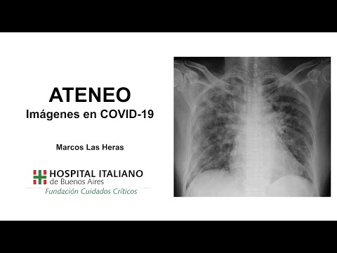 Vídeo: Los Médicos Mostraron Imágenes De Pulmones Afectados Por Coronavirus - Vista Alternativa