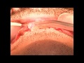 Gingivoplasty by diode laser drahmad abu aesha