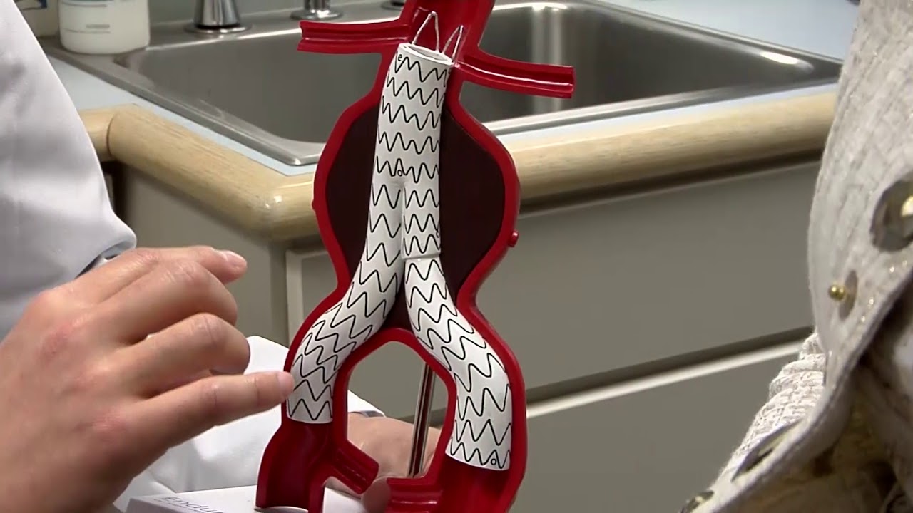 HealthBreak: Abdominal Aortic Aneurysm - YouTube