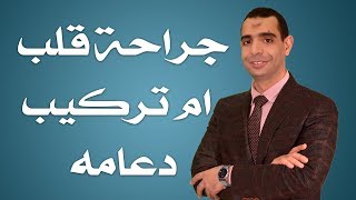 جراحة قلب ام تركيب دعامة- دكتور احمد الوكيل إستشاري جراحة القلب والصدر