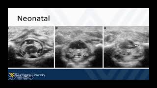 Fundamentals of POCUS Guided Procedures 5 - Lumbar Puncture and Summary