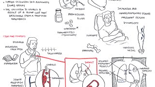 Pulmonary Embolism - Overview